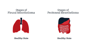 Doctors use the staging system to help determine a patient's prognosis and treatment options. How Do You Die From Mesothelioma Elg Law