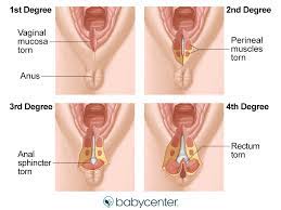 Most women feel relief from any pain caused by a vaginal tear in about two weeks. Everything You Need To Know About Perineal Tearing During Labor Babycenter