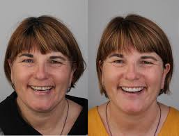 Injectable technique