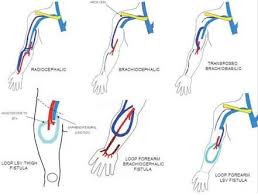 Image Result For Arteriovenous Fistula Hemodialysis Dialysis Nurse Vascular Ultrasound Diagnostic Medical Sonography