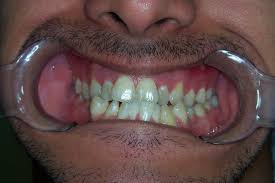 Even adults get braces, almost 1.5 million of them every year, and the length of time you wear braces depends on your medical and dental history and the severity of your overbite. Common Problems Braces Fix