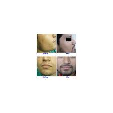 The transplanted hairs will shed and grow back over the next few month as the hair grafts follow their natural growth cycle. Beard Hair Transplant In Ahmedabad Ellisbridge By Dr M Hair Transplant Clinic Dr Mahadevia Bishan Id 6630836791