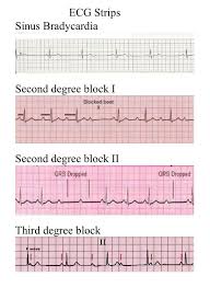 Pin By Martha Fairbanks On Acls Critical Care Nursing Cardiology Nursing Cardiovascular Nursing
