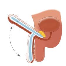 A phalloplasty is the construction or reconstruction of a penis. Zephyr Surgical Implants Faloplastia