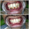 Teeth whitening product image
