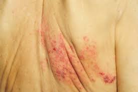 Image result for scabies on genitals