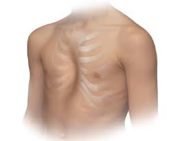 Image result for Pectus Excavatum