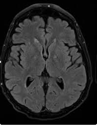 There is no particular age, sex, or seasonal predilection. Fulminant Herpes Simplex Encephalitis With Normal Initial Mri Findings Consultant360