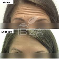 Elsa anka se somete a un tratamiento con botox y nos deja ver el antes y después de esta sesión de medicina estética. Baby Botox Un Tratamiento Sutil Y Efectivo Para Prevenir Las Arrugas