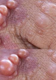 Neurofibromatosis type 1 (nf1) and nf2. Therapeutic Development In Neurofibromatosis Intechopen