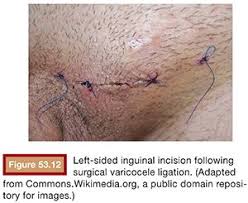 Image result for Varicocele