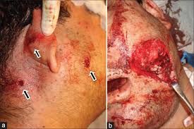 It very much depends on the type of shot; Management Challenges In A Short Range Low Velocity Gunshot Injury