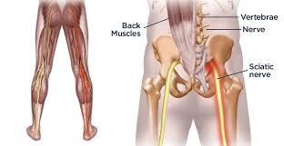 The most common symptom of sciatica is lower back pain that extends through the hip and buttock and down one leg. 7 Poses To Soothe Sciatica
