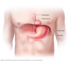 Image result for stomach hernia symptoms