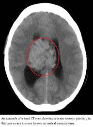 Lateral ventricles apertures dogs cats limited radiation. Www Leedsneurosurgery Com Patient Information Brain Tumours