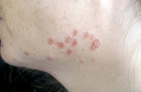 Since these are so common, there's definitely. File Cutaneous Findings In Systemic Sarcoidosis Jpeg Wikipedia