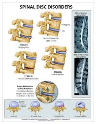 Spinal Disc Disorders Anatomical Wall Chart Peel And Stick