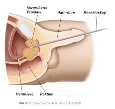 Wie lange nach einer ausschabung muss man denn warten, bis man wieder sex haben darf. Transurethrale Resektion Der Prostata Turp Pi De