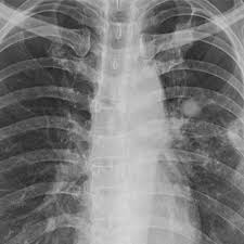 Exame De Nodulo De Pulmao Em Joinville Santa Catarina Medico Cirurgiao Toracico