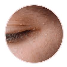 Image result for milium cyst on eyelid