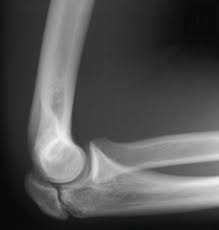 Image result for Elbow XRay