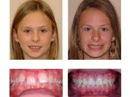 Holistic Orthodontics Is An Alternative To Traditional Braces