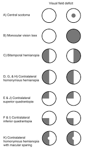 Image result for Visual Field Deficit