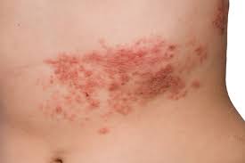What causes shingles in young adults. Young People Can T Get Shingles Right Wrong For Better Us News