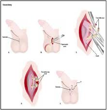 It's not possible to give percentages of recanalization, and late clearance as most studies cease monitoring men after a set length of time. Vasectomy Procedure Recovery Tube Pain Complications Time Infection Operation
