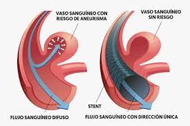 Los aneurismas aórticos pueden producirse en cualquier parte de la aorta y pueden tener forma de tubo (fusiforme) o redonda (sacciforme). Que Es Un Aneurisma Cerebral Sintomas Causas Y Tratamiento Tua Saude