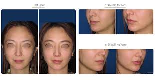 Philtrum Reduction Facial Surgery Wish Aesthetic Surgery Clinic The vertical groove on the median line of the upper lip. philtrum reduction facial surgery