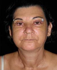 Laser vs. Traditional Blepharoplasty in Patients with Fitzpatrick III to VI