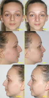 Afla in 5 minute daca operatia este. Rinoplastie Septoplastie ClinicÄƒ ExclusivistÄƒ La Standarde Occidentale