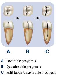 Image result for Tooth Fracture