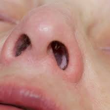 Here, we outline the nasal polyp removal procedure and set out steps for the recovery period Nasal Polyps Michigan Ent Allergy Audiology