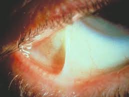 Image result for Pemphigoid