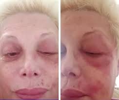 Carmen barbieri se sumó a masterchef celebrity luego de haber estado en coma por coronavirus: Impactantes Imagenes De Carmen Barbieri Afectada Por La Culebrilla Diarioshow El Portal De Espectaculo