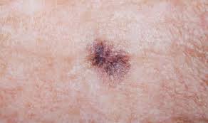Many signs of skin cancer are unnoticeable until it is too late if careful examination is not done regularly. Skin Cancer Symptoms Warning Signs Your Mole Is Melanoma How To Prevent It Express Co Uk