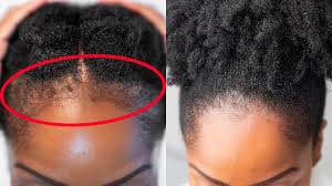 Women with receding hairlines should stick to short cuts. Grow Back Your Edges Faster With These 5 Simple Tips Youtube