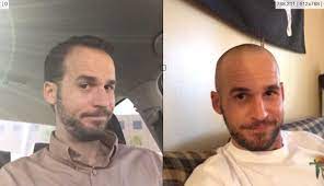 Receding Hairline To A 1 Bald