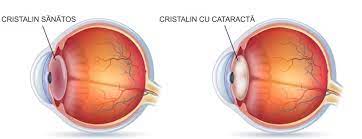 Pentru a descoperi care este cristalinul artificial potrivit pentru dumneavoastra, este necesar sa efectuam o consultatie oftalmologica si un set de masuratori specifice. Cristalin Arhive Cristal Vision