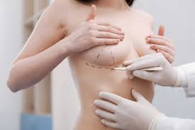 How to Find the Best Breast Surgeon in Sydney | Dr Rizk