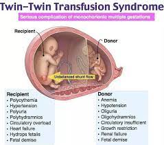 Pin On Twin To Twin Transfusion Syndrome Ttts