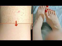 مرة واحدة فقط وانسي الشعر تحت الجلد جلد الاوزة والنقط الحمرا وتفتيح خي Natural Skin Care Felt Embroidery Beautiful Skin