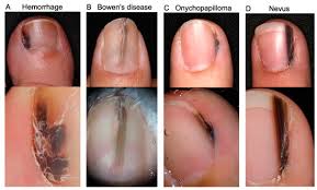 Image result for Acral lentiginous melanoma nail