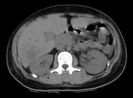 Resumen la mucormicosis es una infección micótica sistémica y oportunista; Https Www Medigraphic Com Pdfs Abc Bc 2008 Bc082g Pdf