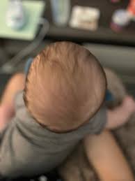 تسطّح الرأس (Plagiocephaly)