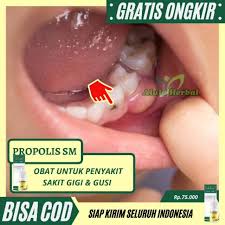 Sakit gigi sembuh, begini cara mengobati gusi bengkak secara alami 100% sembuh. Obat Sakit Gigi Berlubang Berdarah Bolong Gusi Bengkak Sariawan Herbal Propolis Sm Shopee Indonesia