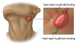 Check spelling or type a new query. Cac Giai Ä'oáº¡n Va Sá»± Tiáº¿n Triá»ƒn Cá»§a Ung ThÆ° Háº¡ Há»ng Vinmec
