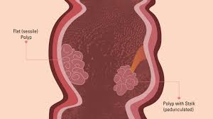 The long, coiled, tubelike organ that removes water from digested food. Types Of Colon Polyps Colon Polyp Symptoms And Risk Factors